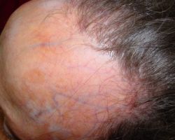 Frontal-Fibrosing-Alopecia