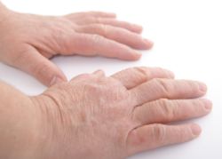 Hand-Eczema