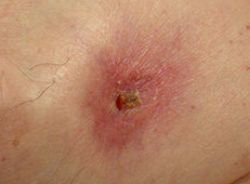 hidradenitis suppurativa