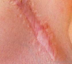 hypertrophic-scar