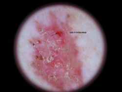 melanocytic-lesions