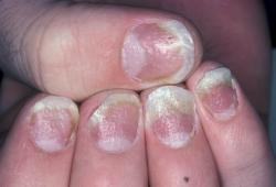 nail-psoriasis