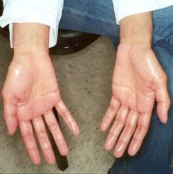 palmar hyperhidrosis