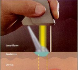 pulsed-dye-laser
