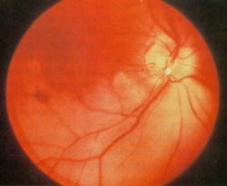 RetinalArteryOcclusion