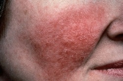 rosacea