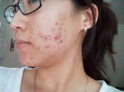 severe-acne