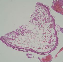 Tender-cutaneous-nodules