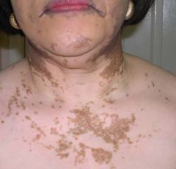 vitiligo05