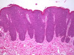 Vulvar-Intraepithelial-Neoplasia