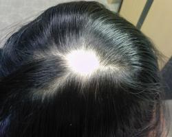 alopecia areata2