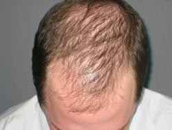 androgenetic-alopecia1