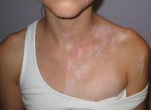 cardiovascular-disease-and-vitiligo