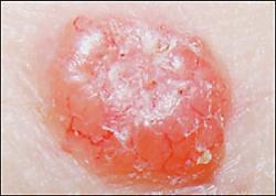 Cutaneous-squamous-cell-carcinoma
