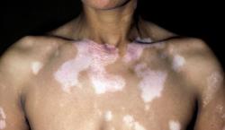 histamine-vitiligo