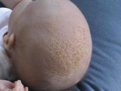 Infantile-Seborrheic-Dermatitis