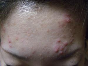 japanese acne