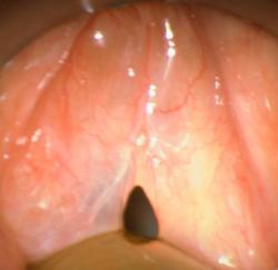 laryngeal-edema