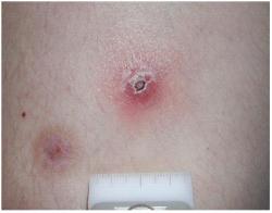 Lymphomatoid-papulosis