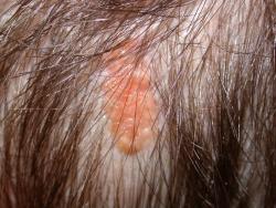 Nevus-Sebaceous