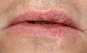 Pulse-granuloma-of-the-lip