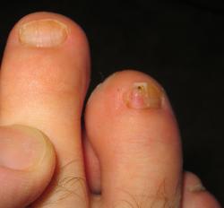 toenail-onychomycosis
