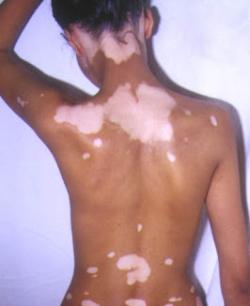 universal-vitiligo