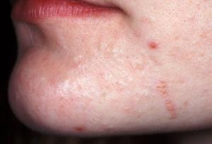 acne-3