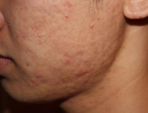 acne-scar-asian