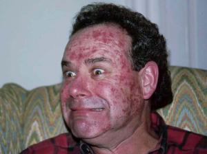 actinic-keratoses-of-the-face