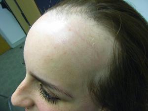 Alopecia-Areata-4