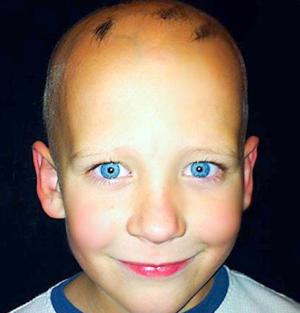 alopecia-in-childhood