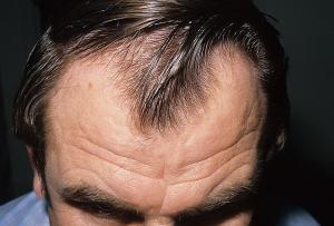 androgenetic-alopecia-3