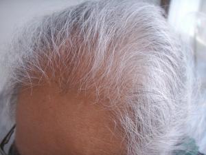 Androgenetic-Alopecia1