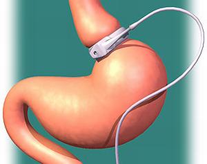 Bariatric-Surgery