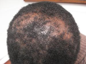 centrifugal-cicatricial-alopecia