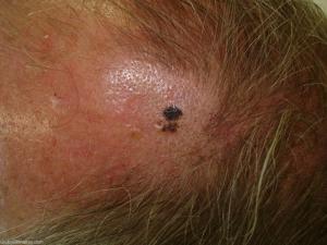 melanoma-of-the-scalp