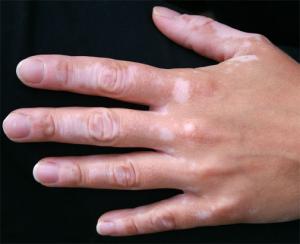 stop-vitiligo-progression