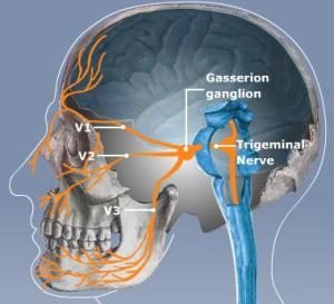 trigeminal-neuralgia