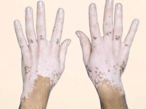 vitiligo-5
