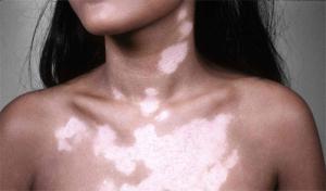 vitiligo-6