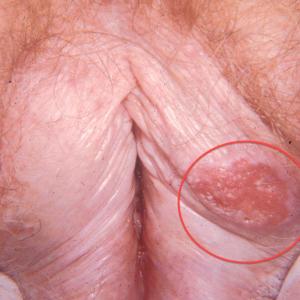 vulvar-lichen-sclerosus