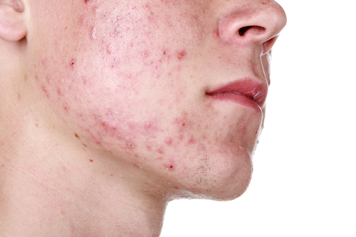 acne young man