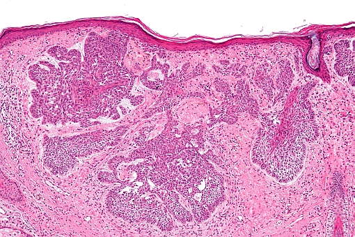 basal cell carcinoma microscopy