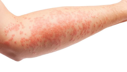 dermatite atopica eczema