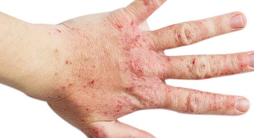 Dermatite atopica mano sinistra