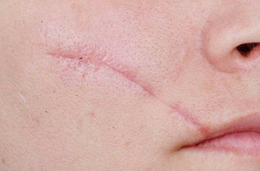 facial scar linear
