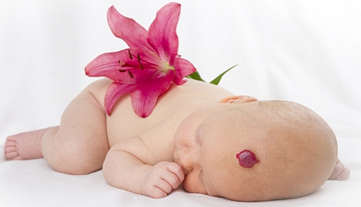 hemoangioma infant