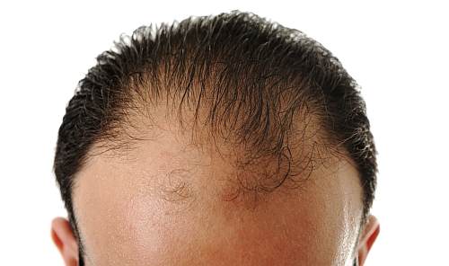 male pattern baldness 43