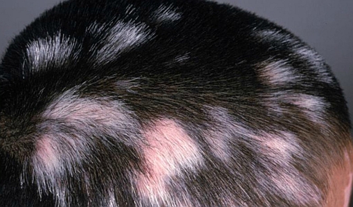 vitiligo hair